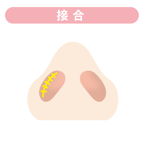 接合