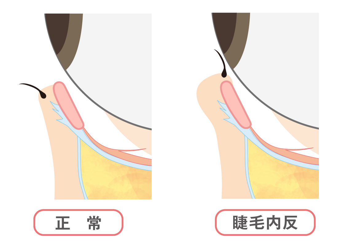先天性の逆さまつ毛