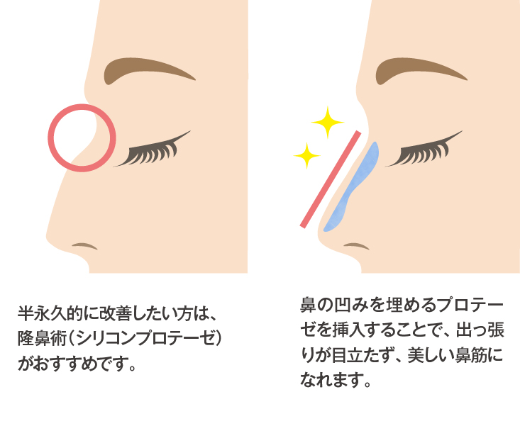 【隆鼻術(シリコンプロテーゼ)