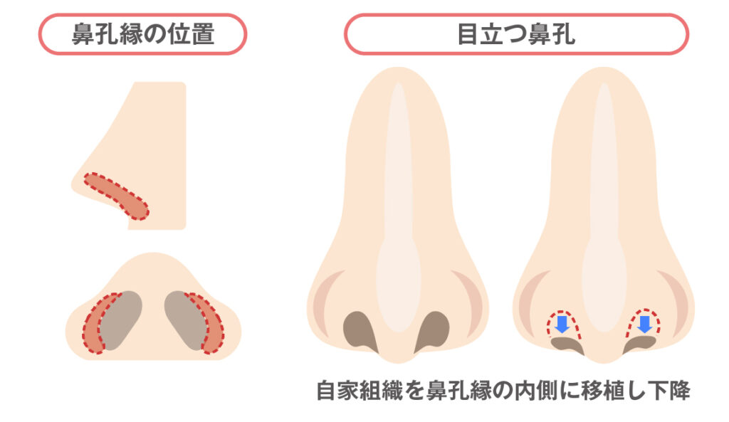 鼻孔縁挙上術・鼻孔縁下降術(フェイスラインも含む)