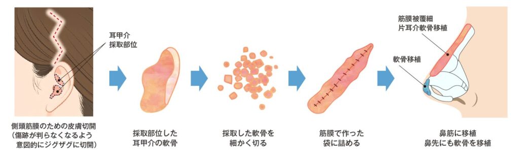 耳介軟骨+筋膜を使用する方法