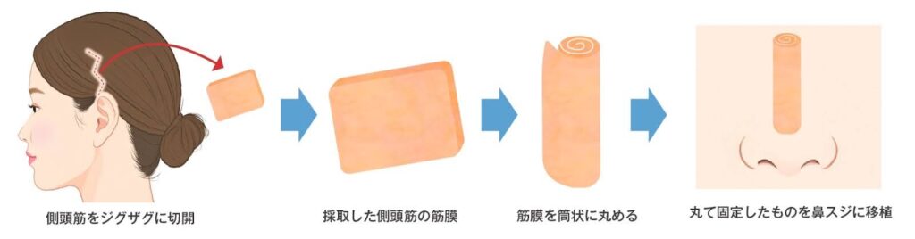 耳介軟骨+筋膜を使用する方法