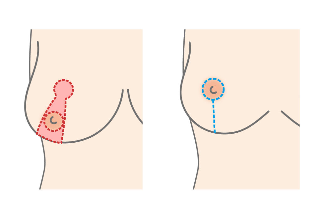 乳房吊上術(バストリフトアップ)