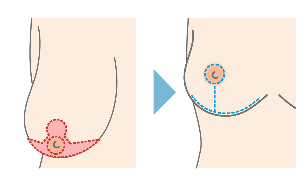 アンカー型（逆T字法）