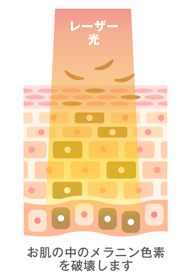 Qスイッチルビーレーザーの効果