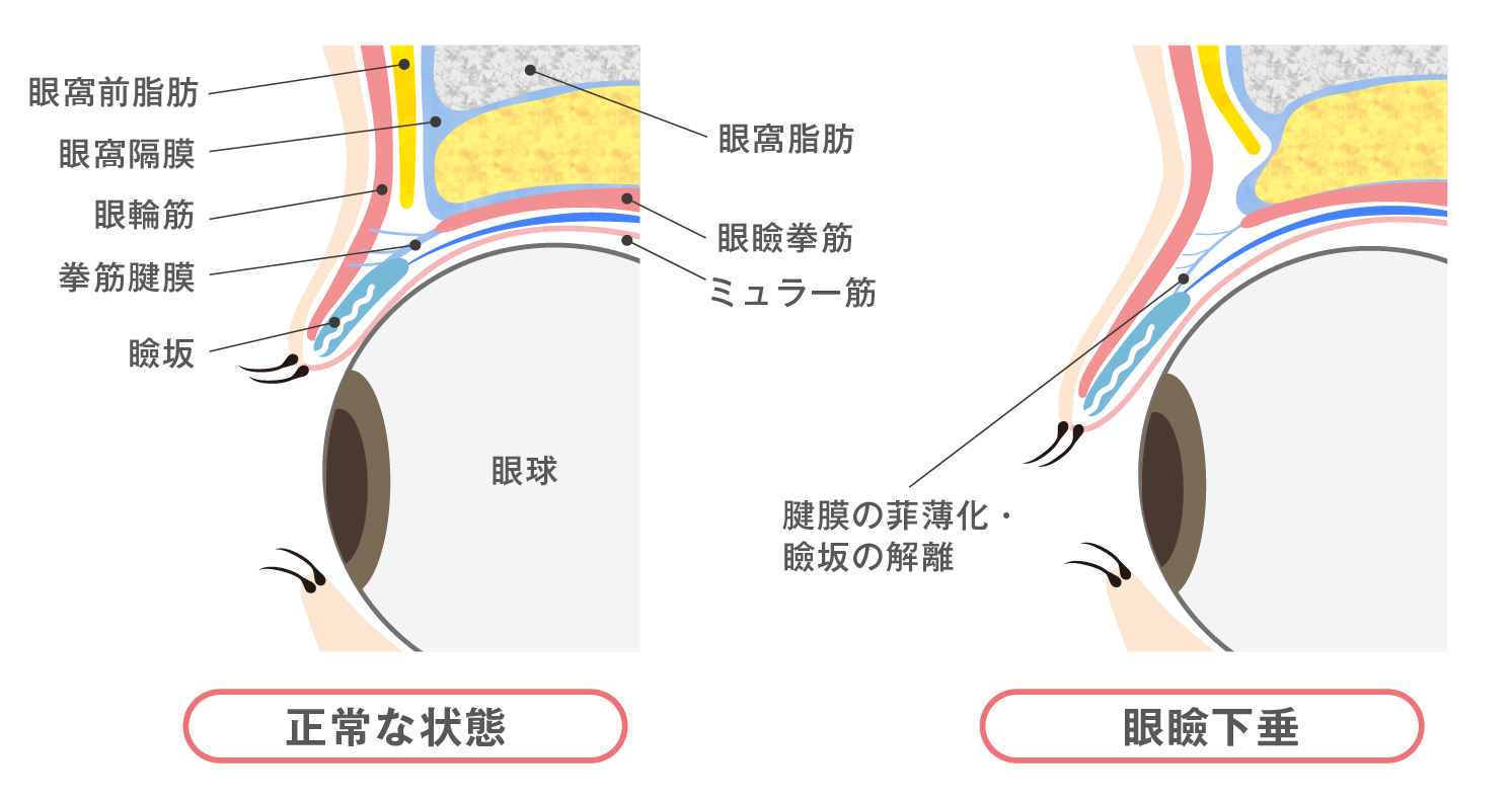 眼瞼下垂