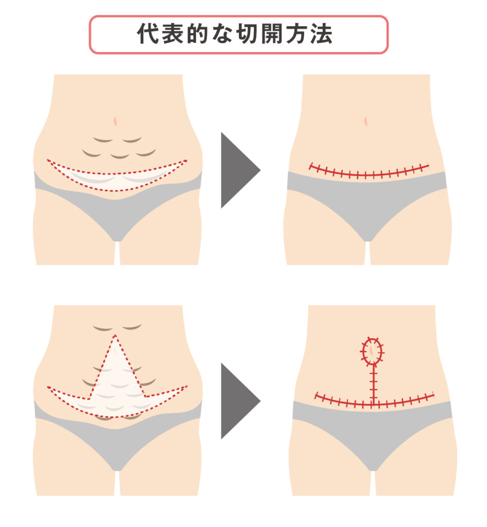 お腹のたるみ取り（タミータック）とは