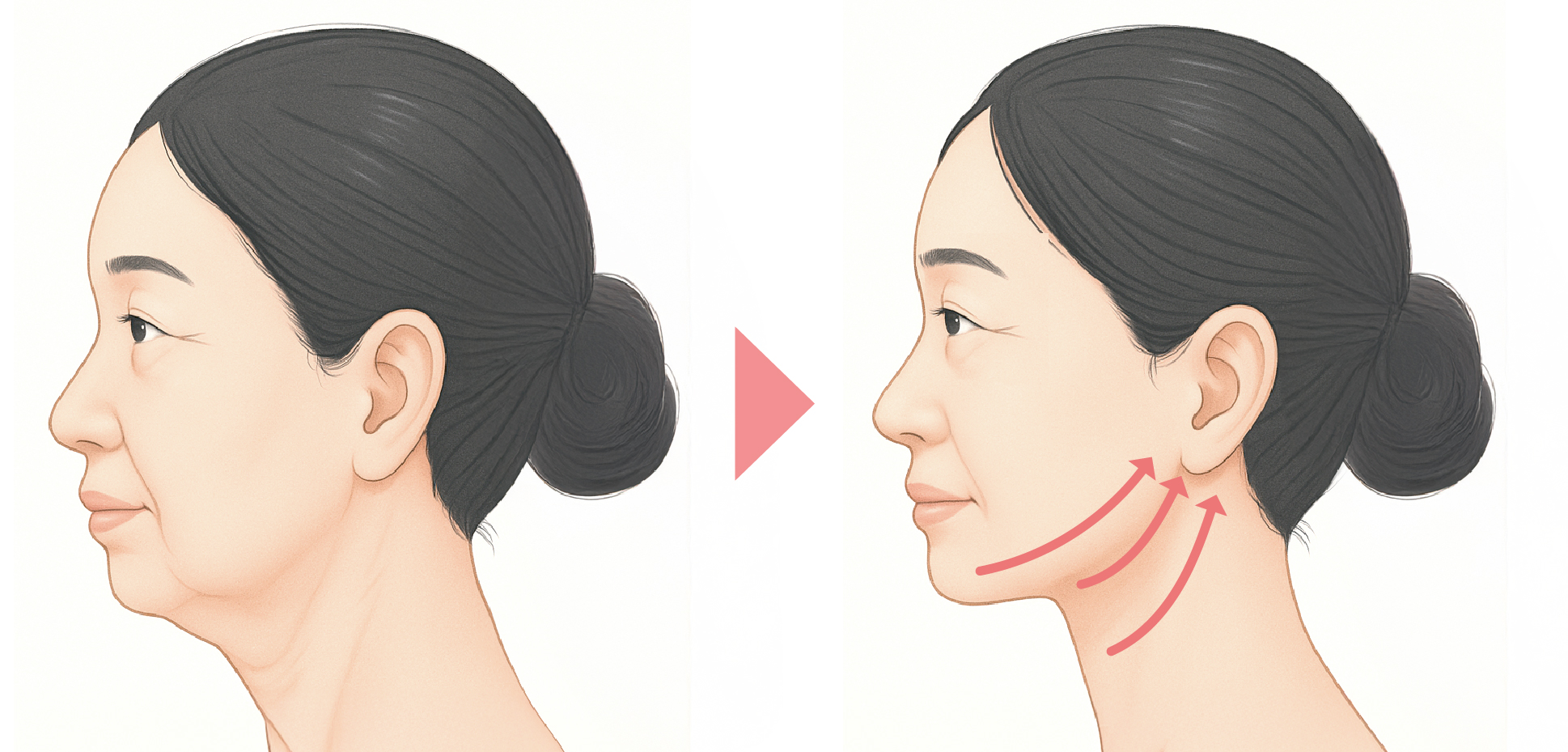 フェイスリフト