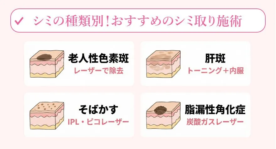 シミの種類別!おすすめのシミ取り施術を紹介
