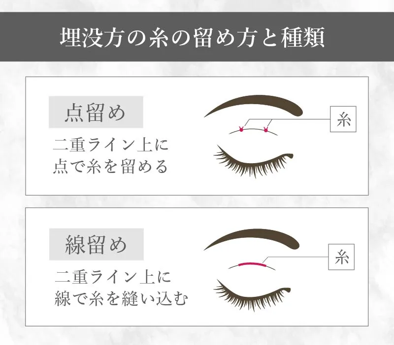 埋没法の種類